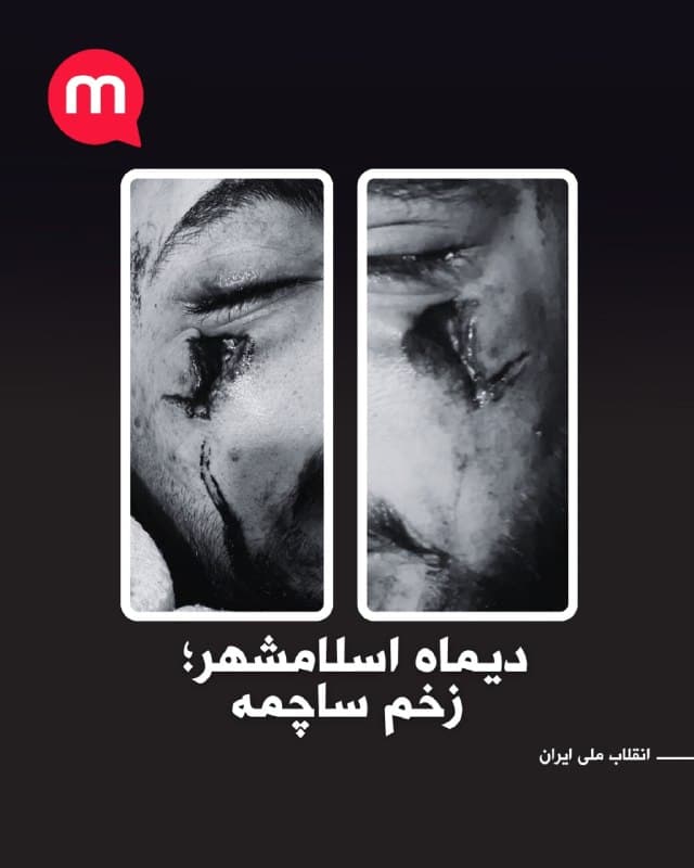 گزارشگر «منوتو» تصویری از خود ارسال کرده که آثار زخم ناشی از اصابت گلوله ساچمهای در نزدیکی چشمش را نشان میدهد.
او میگوید این جراحت در جریان اعتراضات دیماه در اسلامشهر و بر اثر شلیک نیروهای حکومتی به وجود آمده است.
🏁 🇬🇧 ManotoTV
🤖 @VahidOOnLine